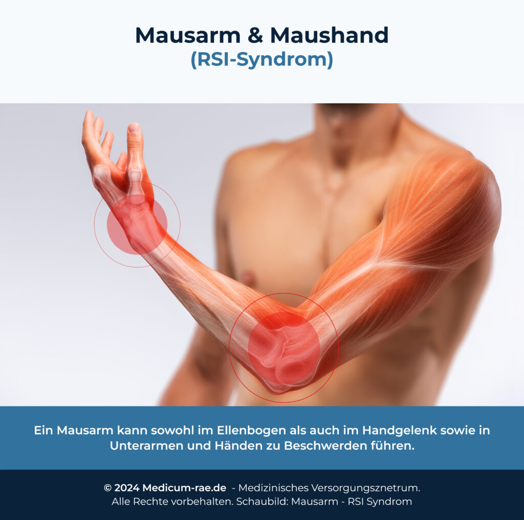 Mausarm & RSISyndrom Alle wichtigen Tipps / MEDICUM RheinAhrEifel