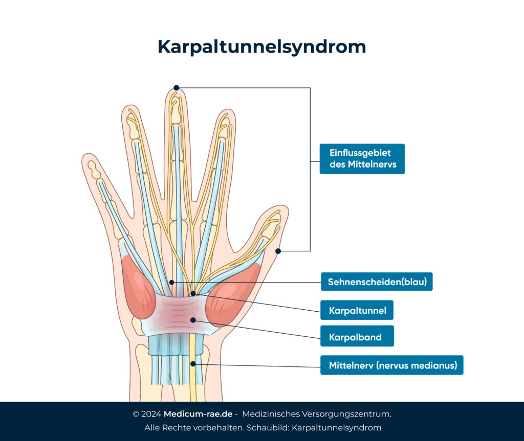 Schaubild: Karpaltunnelsyndrom