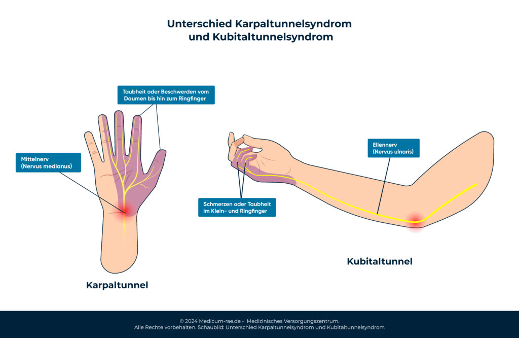 Schaubild: Unterschied Karpaltunnelsyndrom und Kabitaltunnelsyndrom